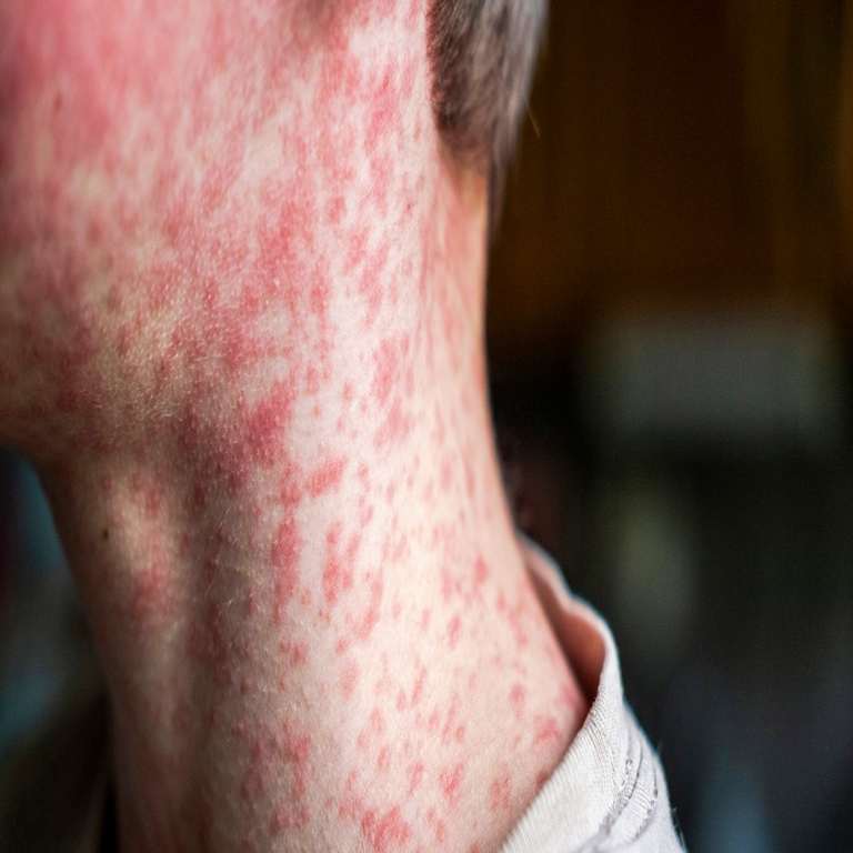 Surge in Measles Cases in South Carolina: A Threat to U.S. Public Health Elimination Status