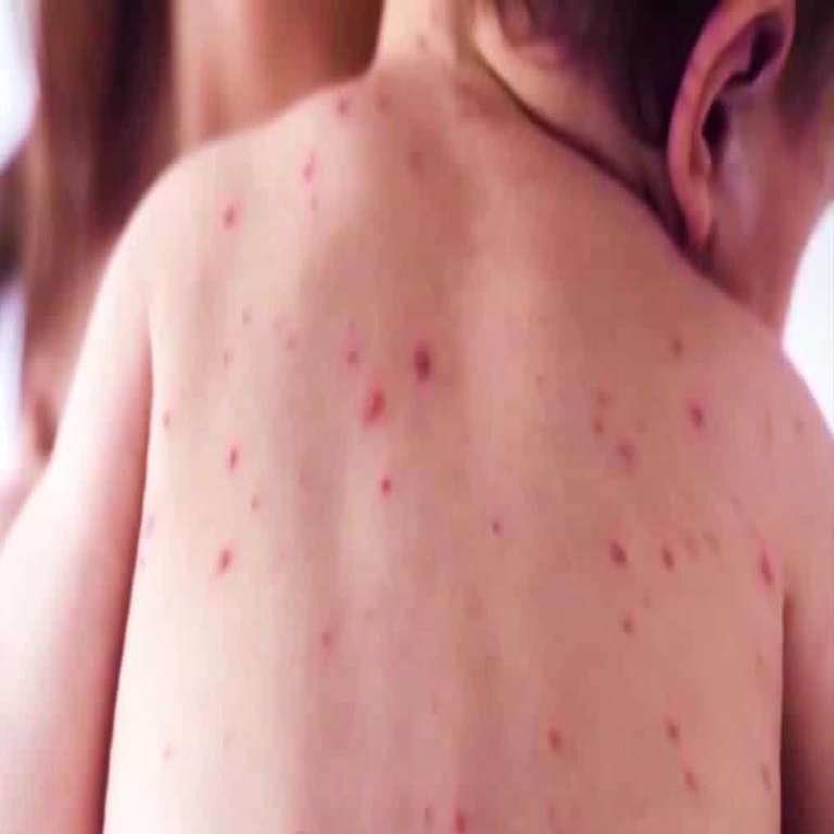 Understanding the Resurgence of Measles Cases in South Carolina